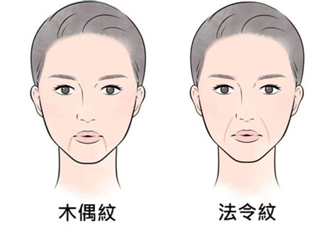 法令紋 木偶紋